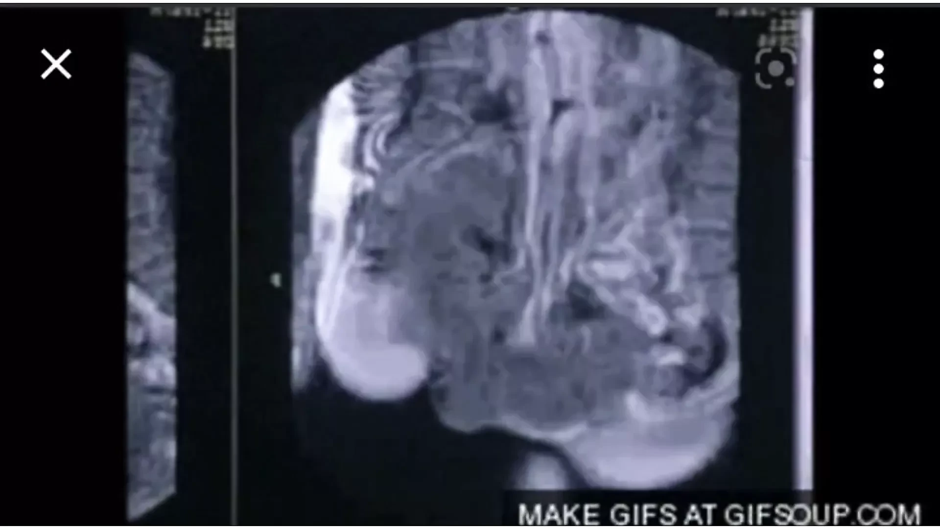 X-ray