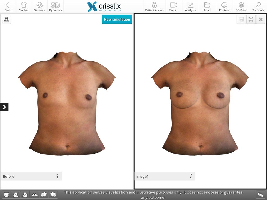 Breast Implant Simulator Breast augmentation 3D simulator breast enlargement 3D images