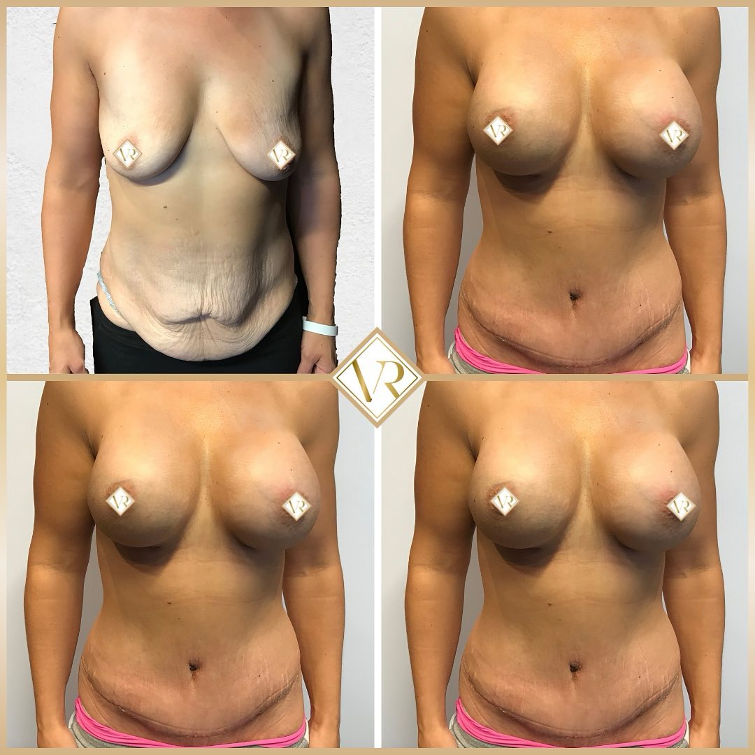 Before After Body Procedures
