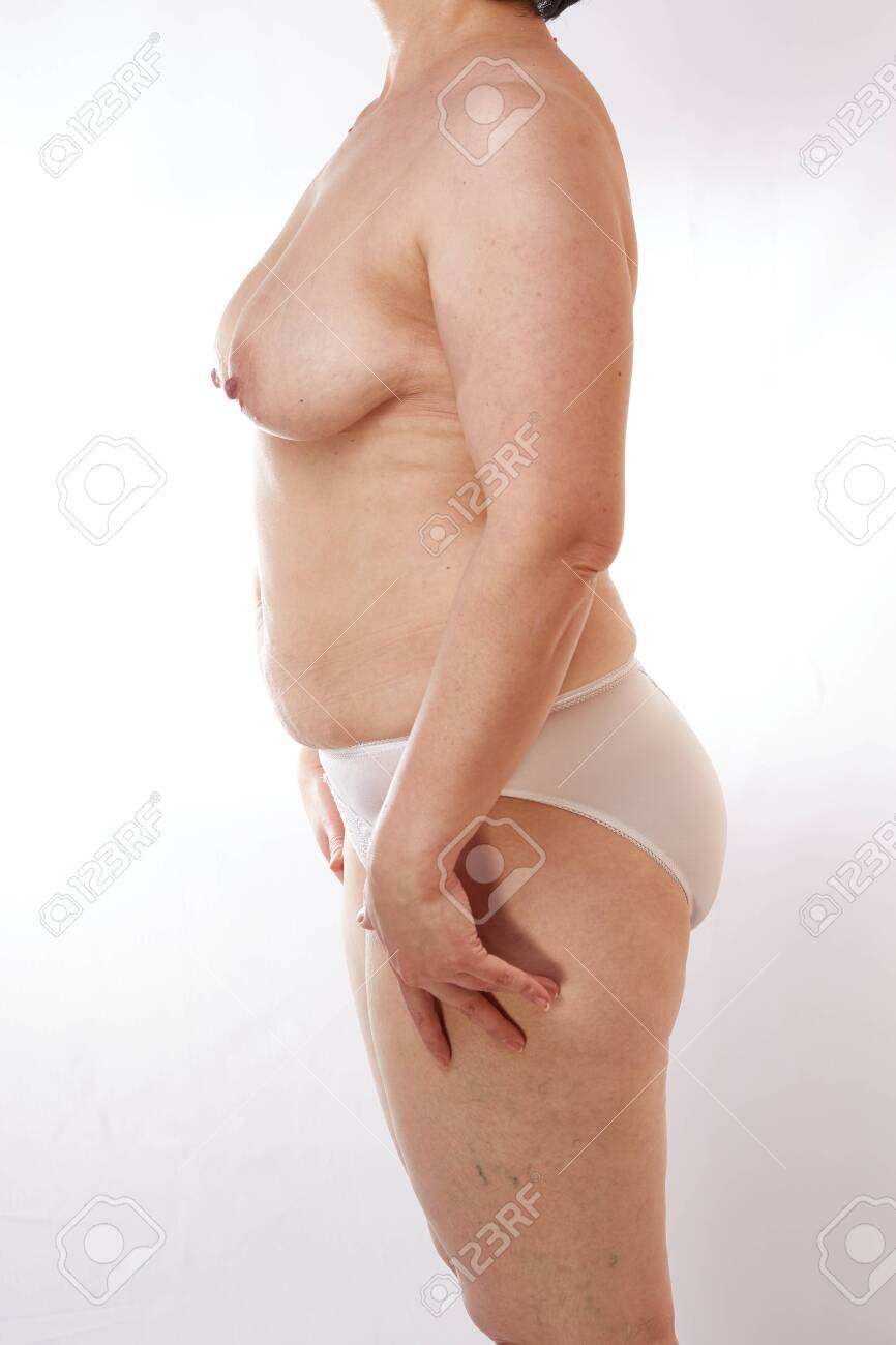 Naked 40-year-old Woman With Sagging Breasts Overweight Stretch Marks And Cellulite On A White Isolated Background. Concept For Medicine And Cosmetology Stock Photo Picture and Royalty Free Image. Image 146104244.