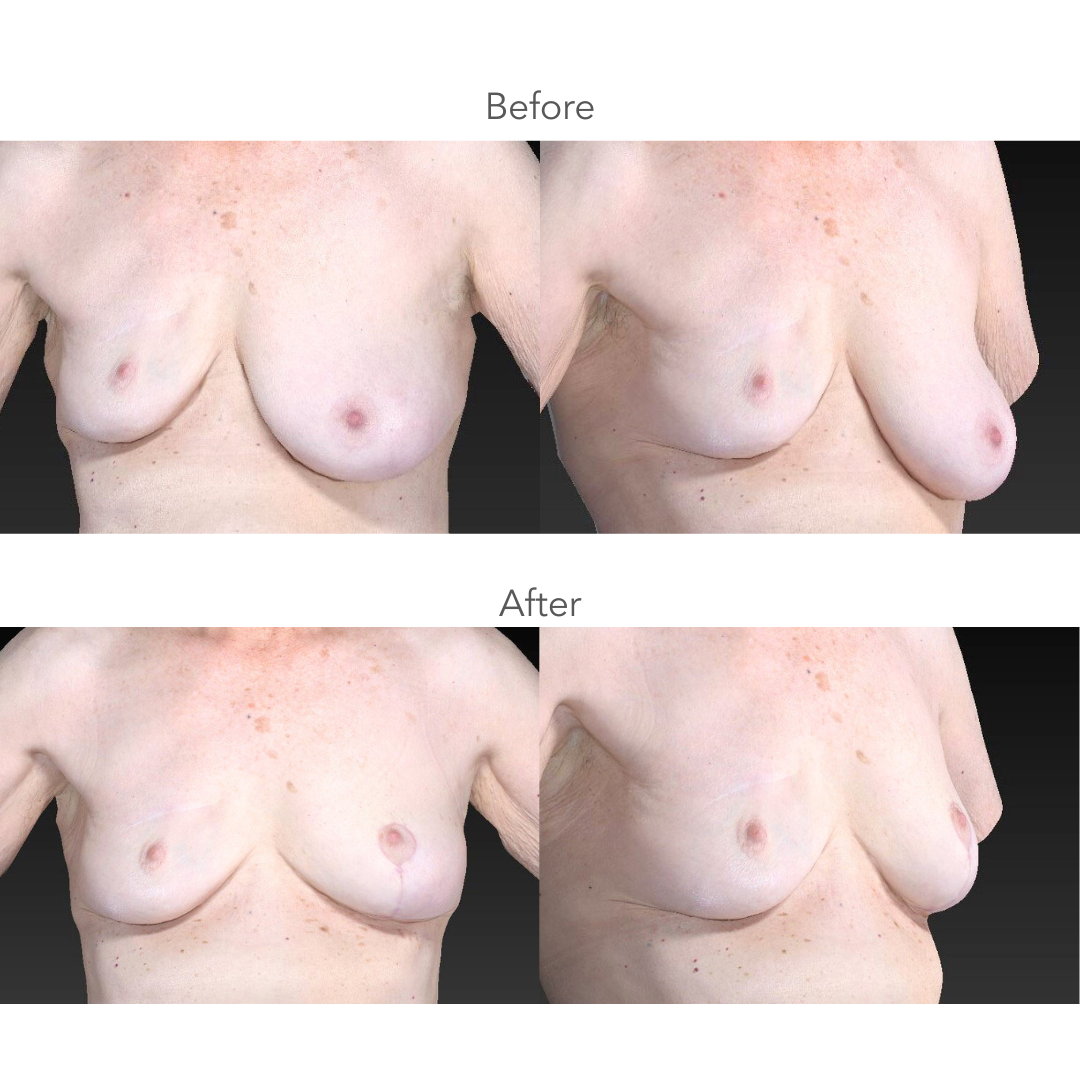 72-year-old-woman-Left-Breast-Reduction-for-Symmetry-51-109-lbs