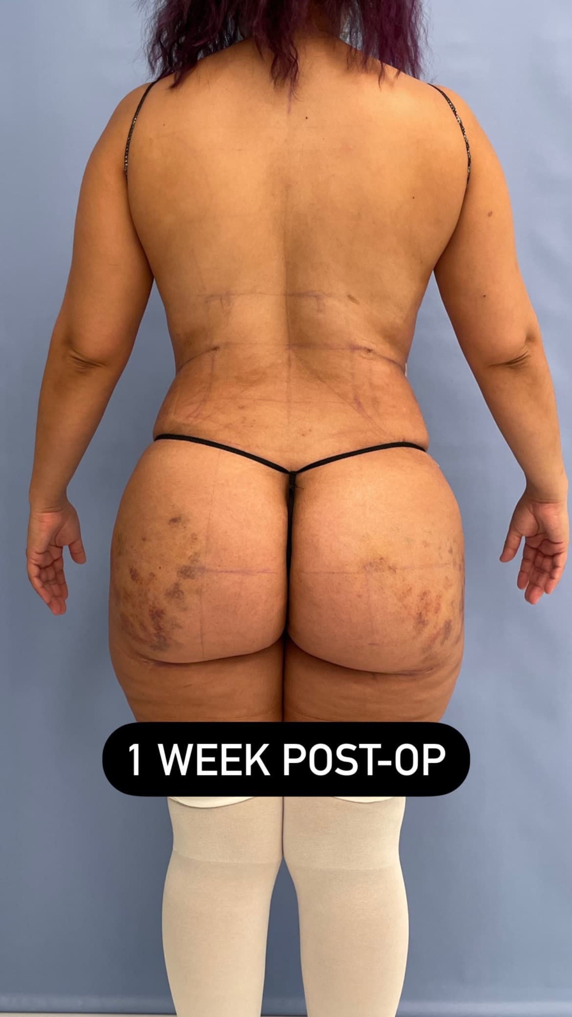 Brazilian Butt Lift BBL Week-By-Week Recovery Timeline