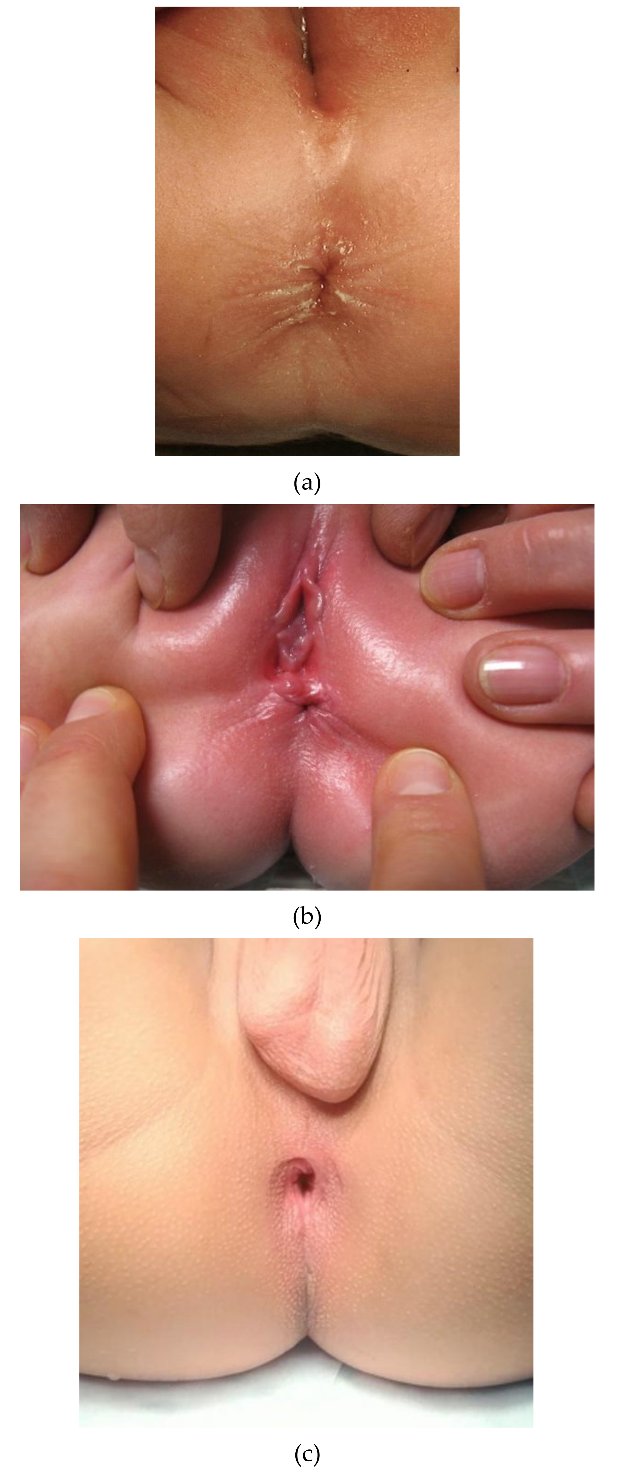 Clinical Differentiation between a Normal Anus Anterior Anus Congenital Anal Stenosis and Perineal Fistula: Definitions and ConsequencesThe ARM-Net Consortium Consensus
