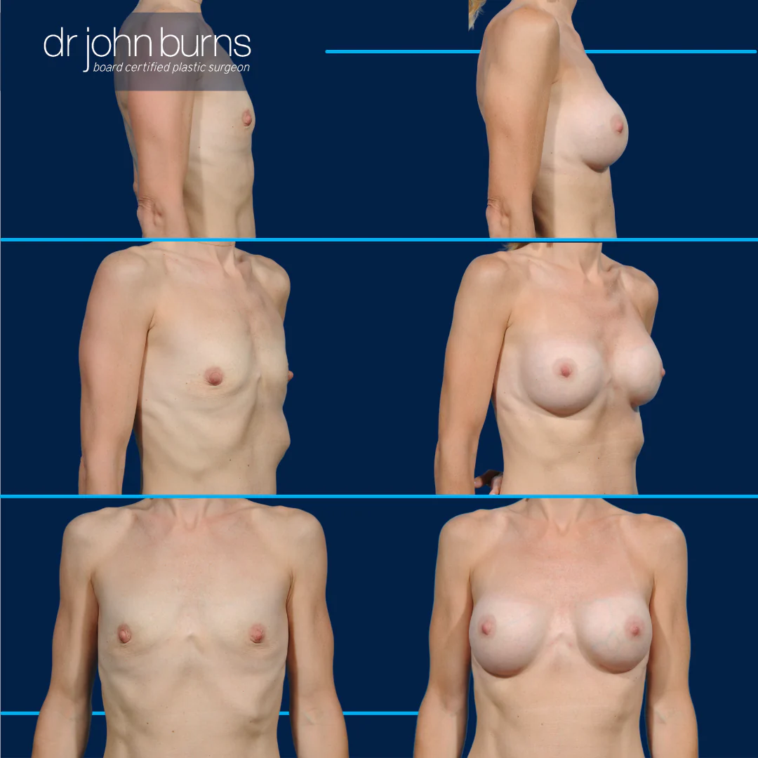 The Tiny Boob Job Thats Taking Over Social Media