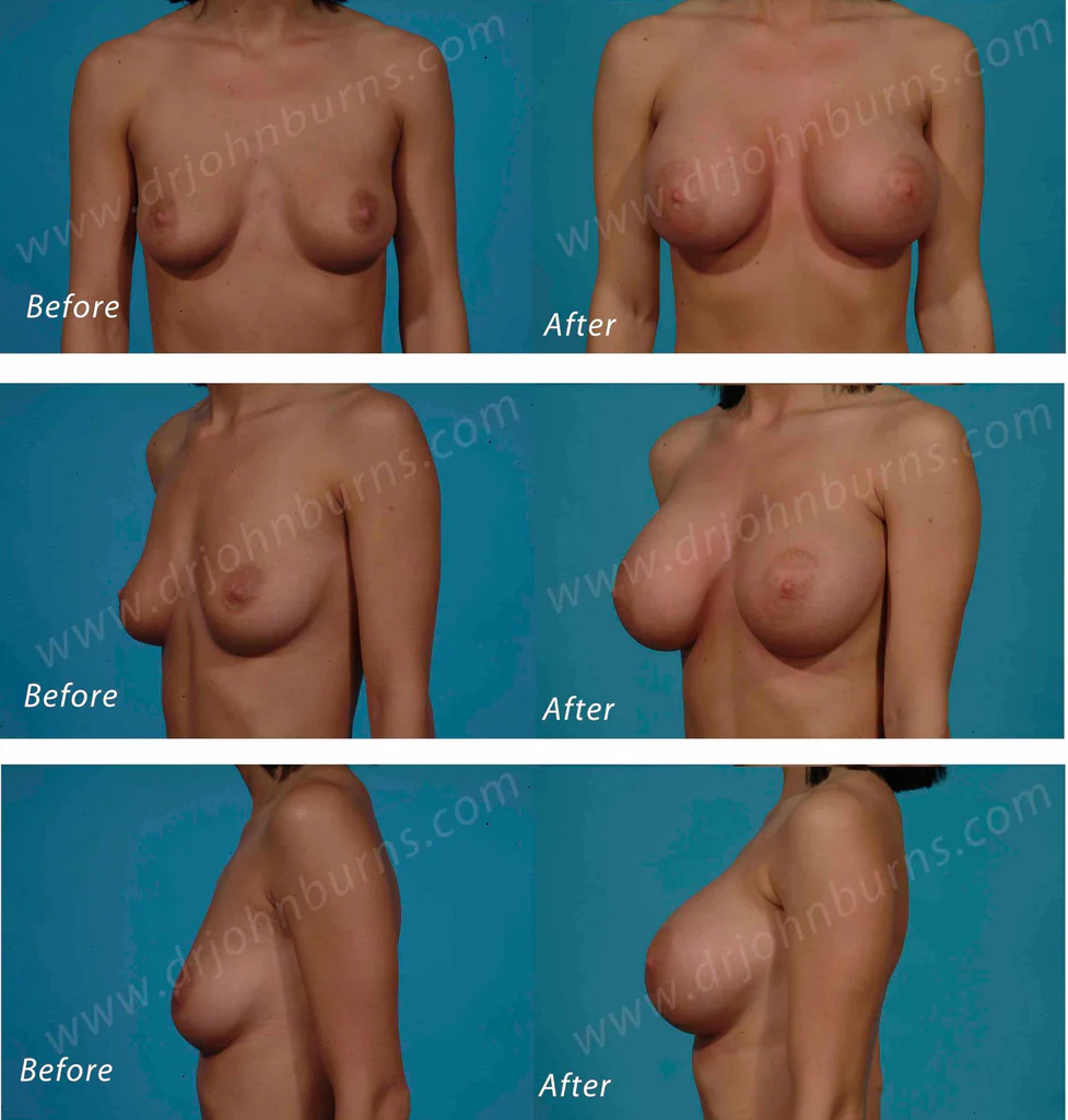 Breast Augmentation: A to D