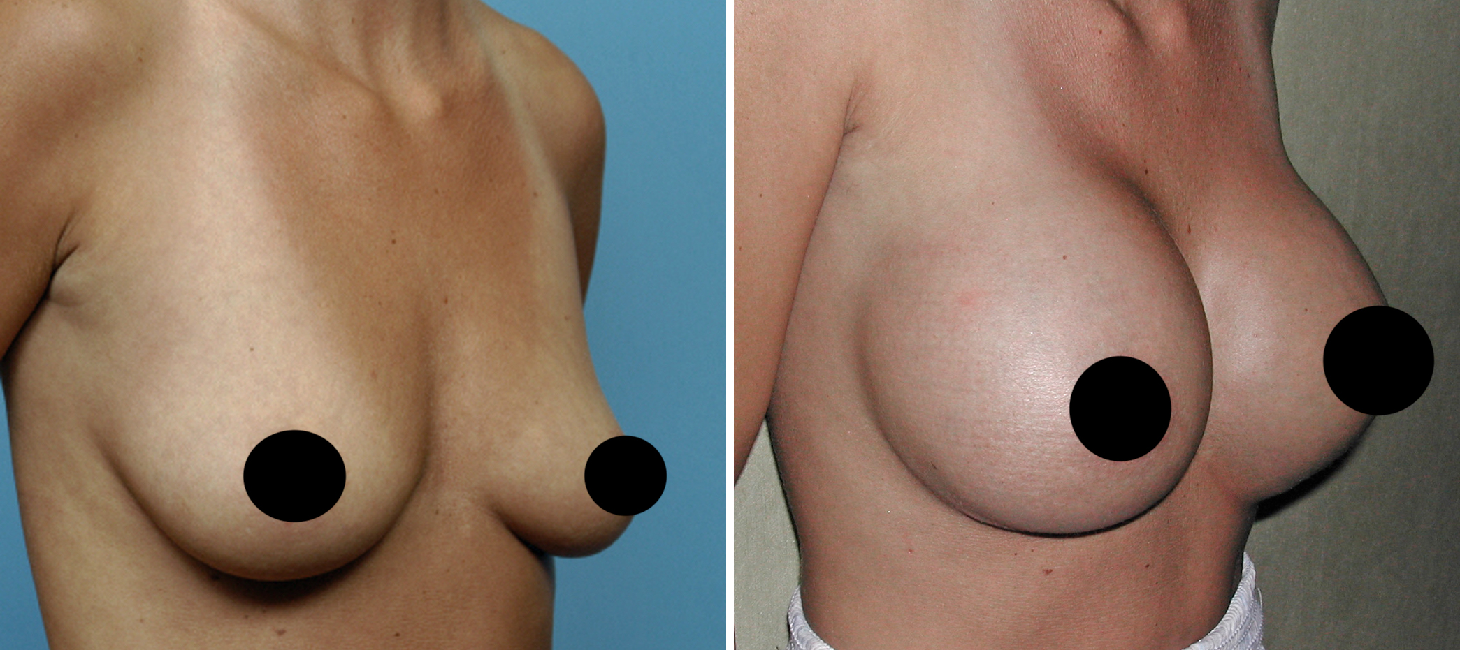 Silicone Breast Implants in Low Hanging Breasts result oblique view Dr Barry Eppley Indianapolis