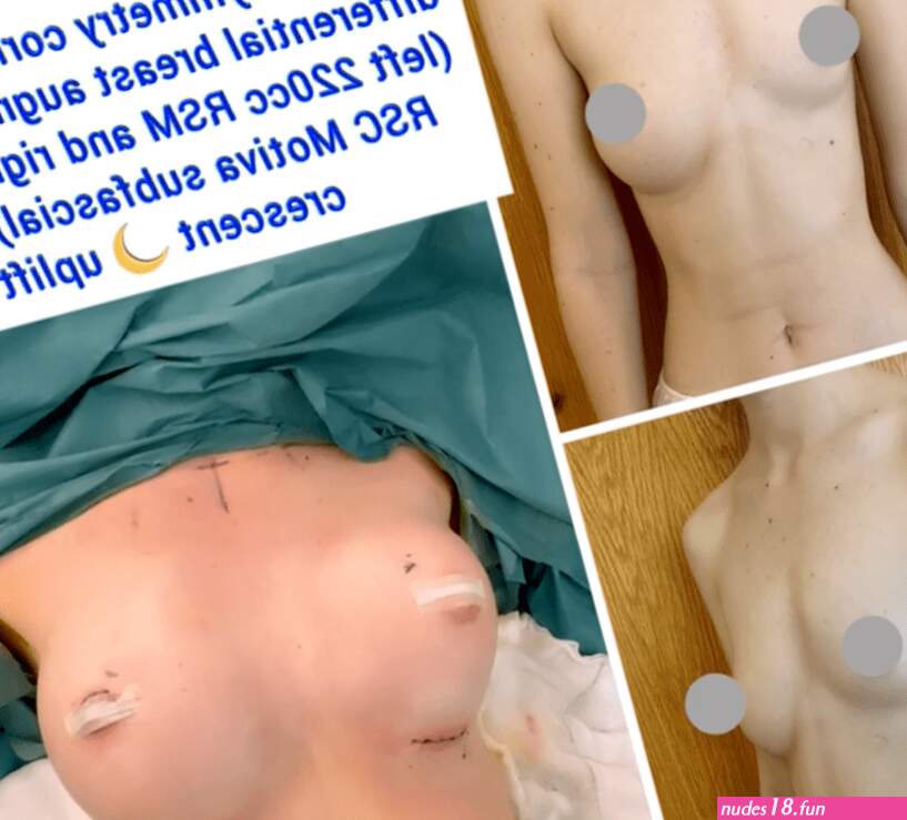 What Causes Breast Asymmetry and How to Fix it