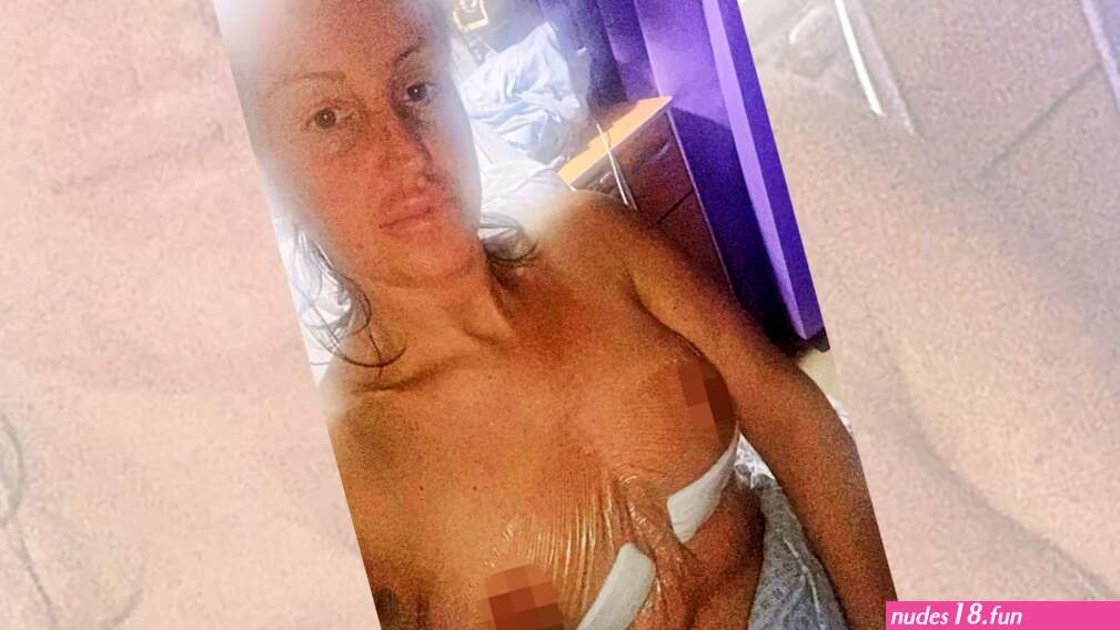 My boobs are EXPLODING! I had cut-price surgery. Now I hate my body even more than before