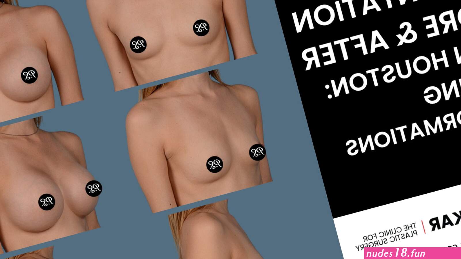 Breast Augmentation Before and After Pics in Houston: Stunning Transformations