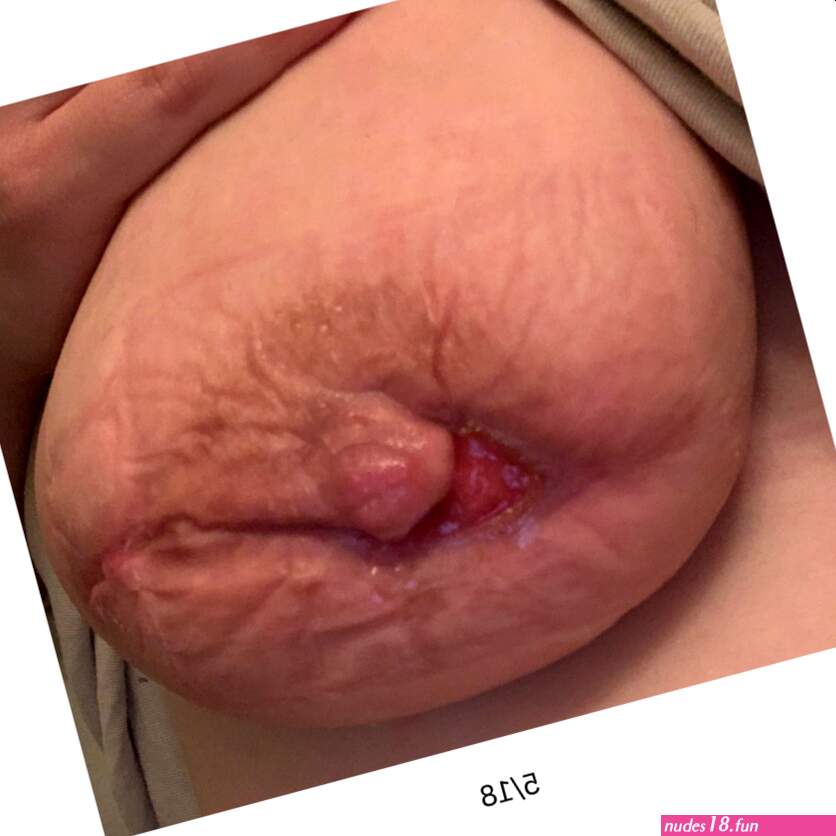 Mastitis Engorgement and Breast Complications with Images