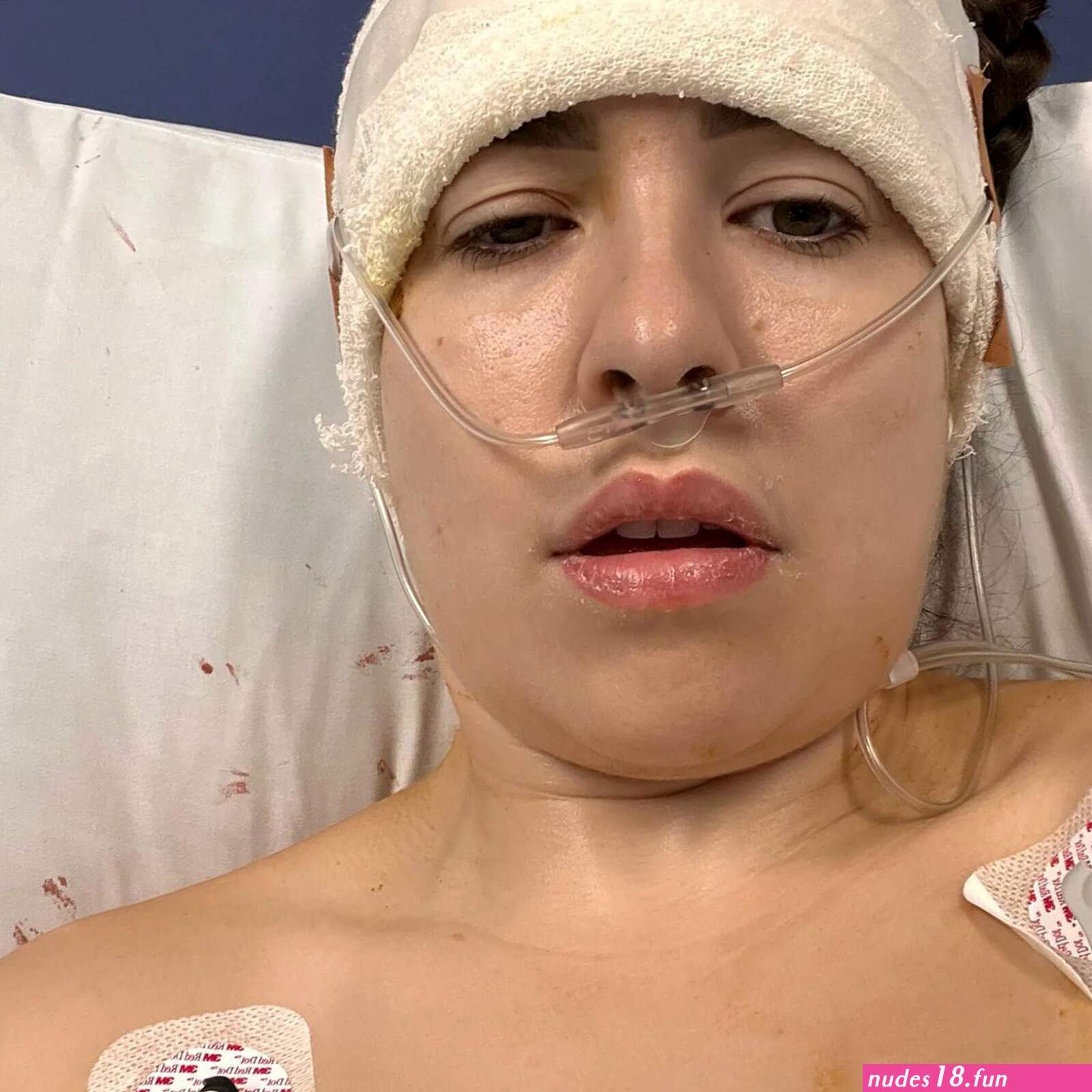 OnlyFans model has brain surgery kept taking nudes in hospital