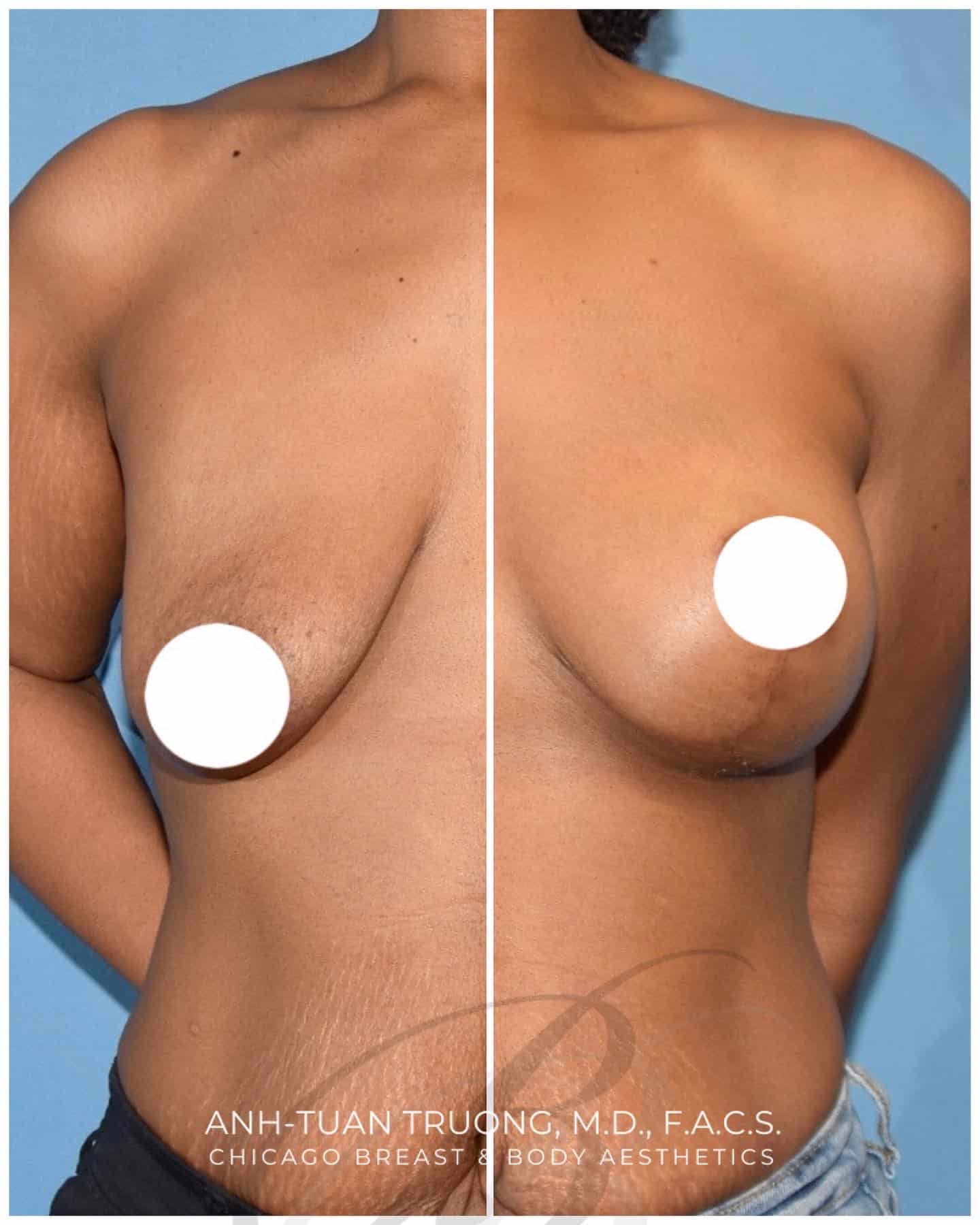 1 Rated Breast Lift Mastopexy Surgeons