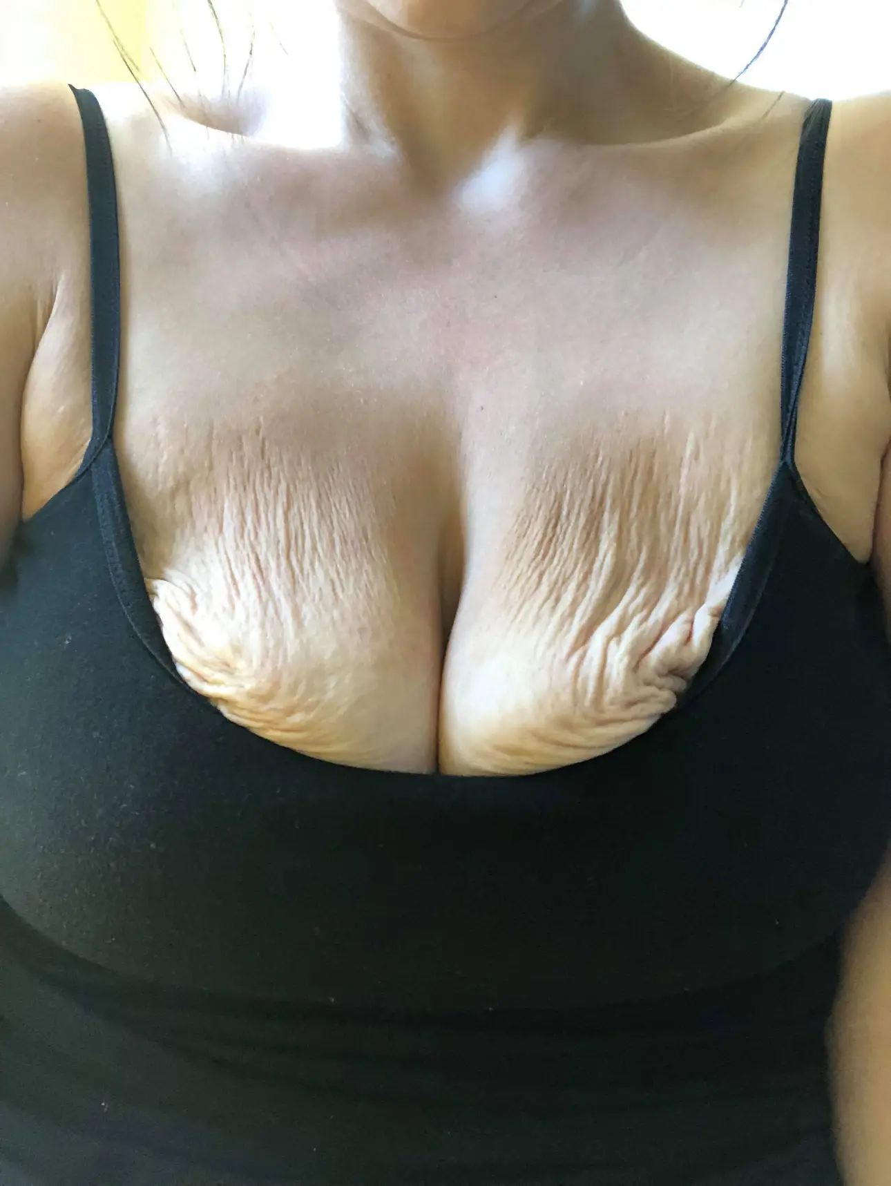Lets Talk TaTas: How Extreme Weight Loss Affected my Breasts