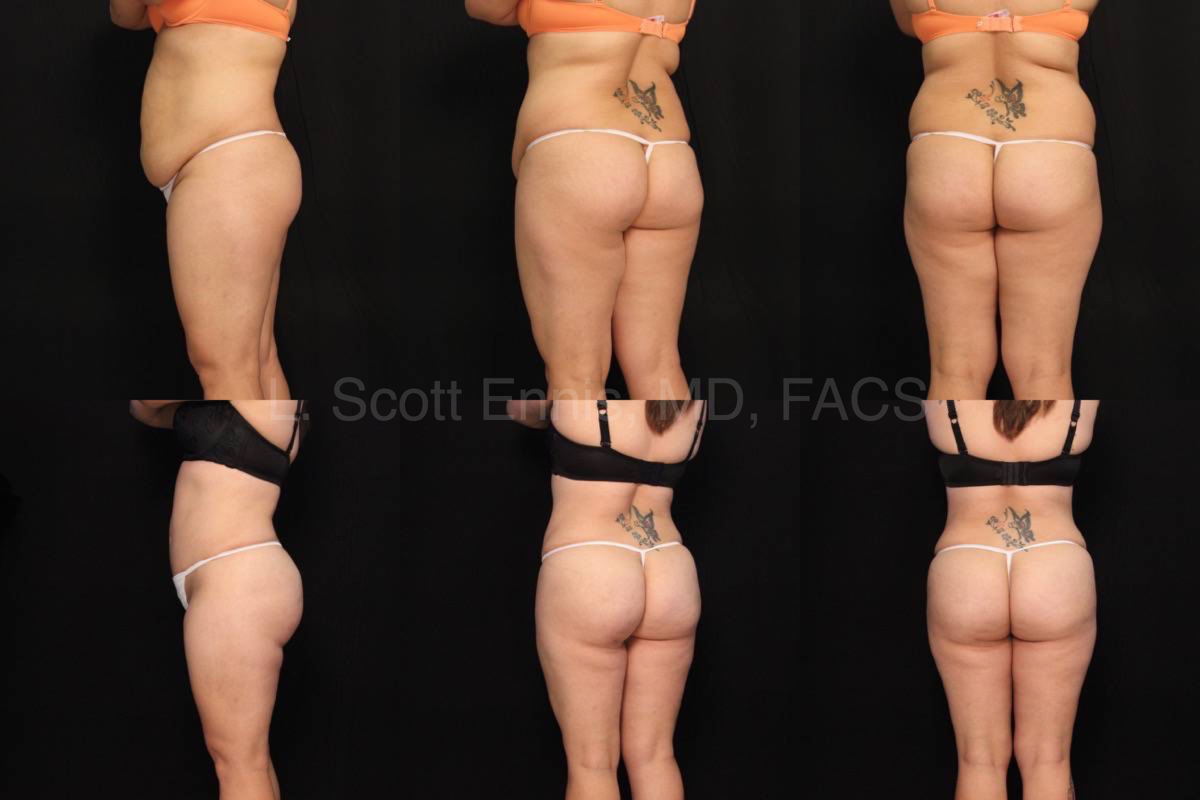 BBL Brazilian Butt Lift Surgery Before After