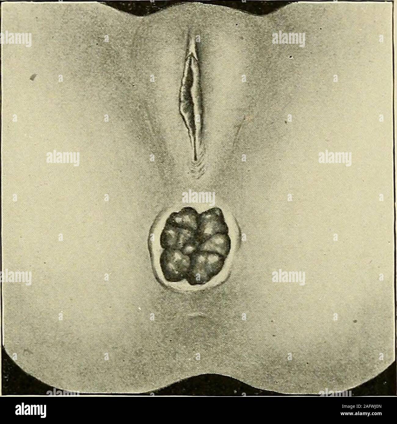 Diseases of the rectum and anus: designed for students and practitioners of medicine. it is best to do this under general anesthesia. Divul-sion can be accomplished however by the use